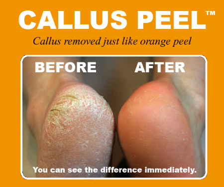 Callus Peel